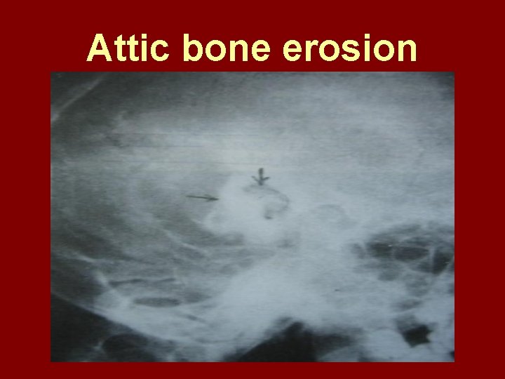 Attic bone erosion 