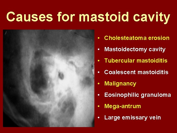 Causes for mastoid cavity • Cholesteatoma erosion • Mastoidectomy cavity • Tubercular mastoiditis •