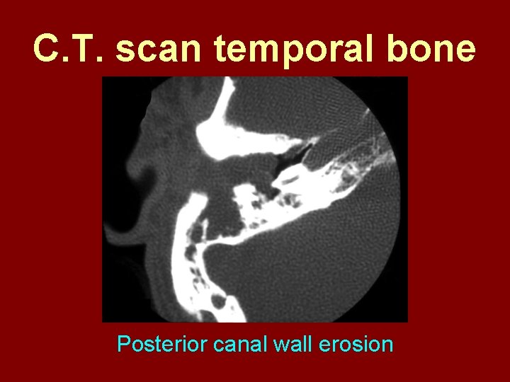 C. T. scan temporal bone Posterior canal wall erosion 