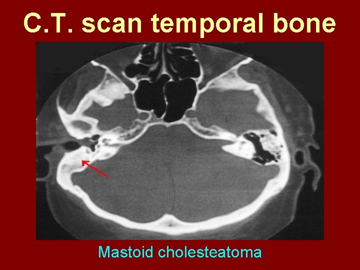 C. T. scan temporal bone Mastoid cholesteatoma 