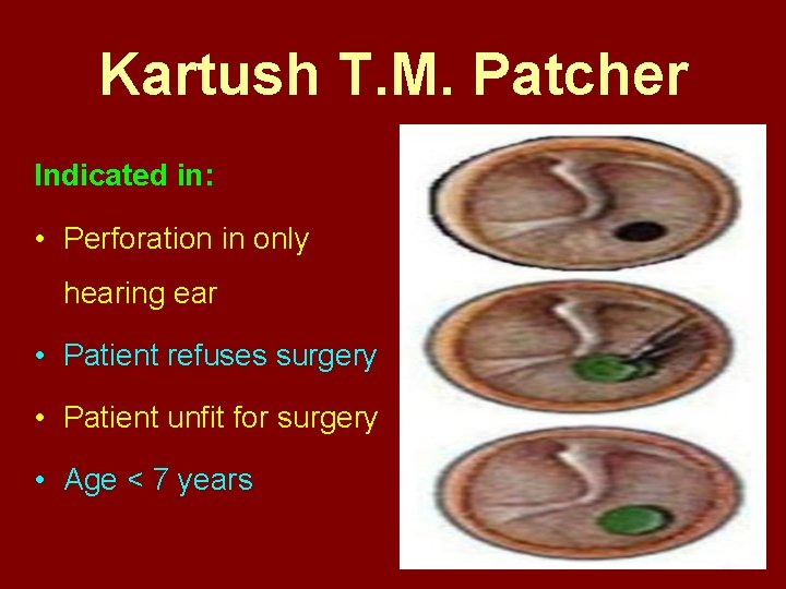 Kartush T. M. Patcher Indicated in: • Perforation in only hearing ear • Patient