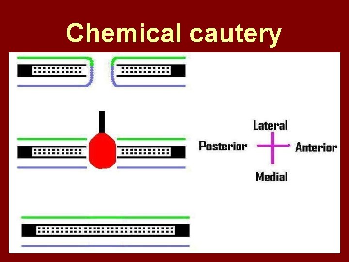 Chemical cautery 