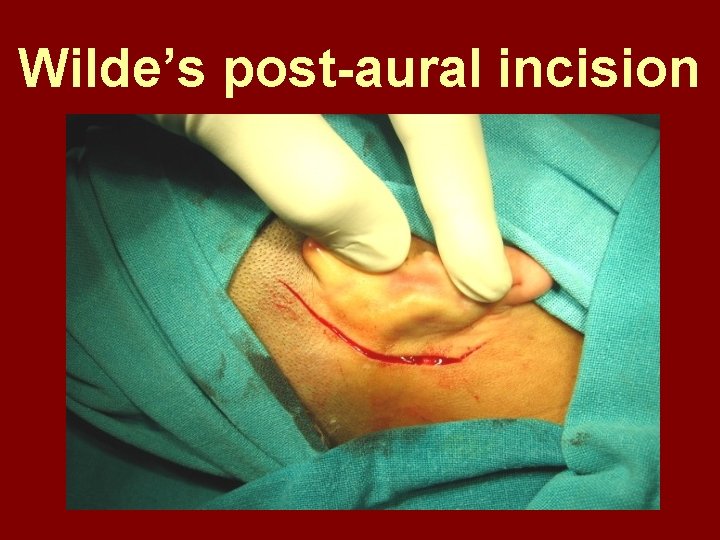 Wilde’s post-aural incision 