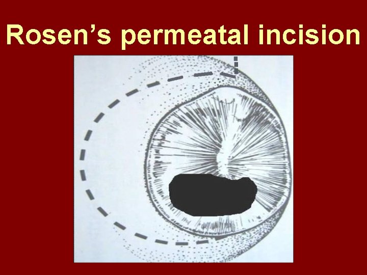 Rosen’s permeatal incision 