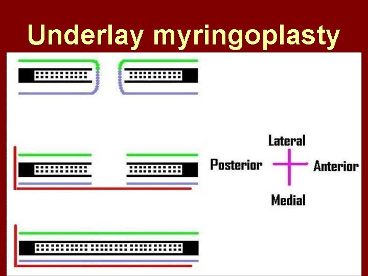 Underlay myringoplasty 