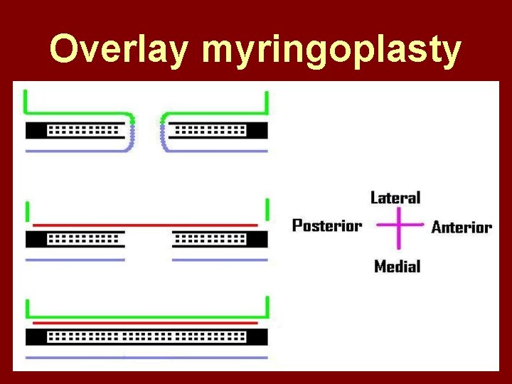Overlay myringoplasty 