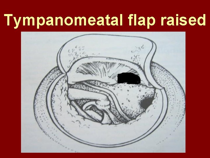 Tympanomeatal flap raised 