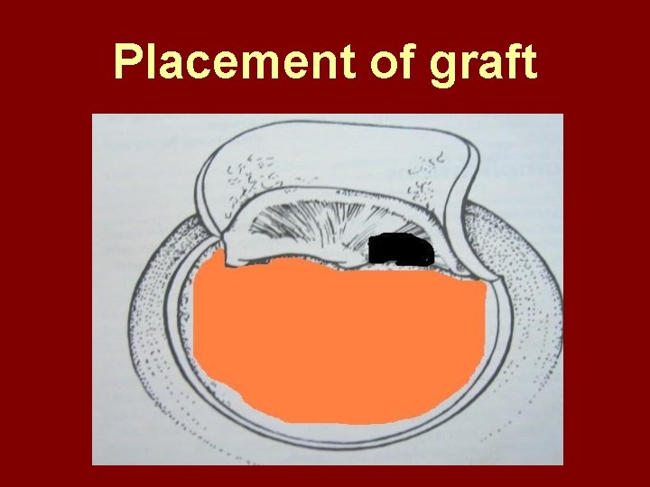 Placement of graft 