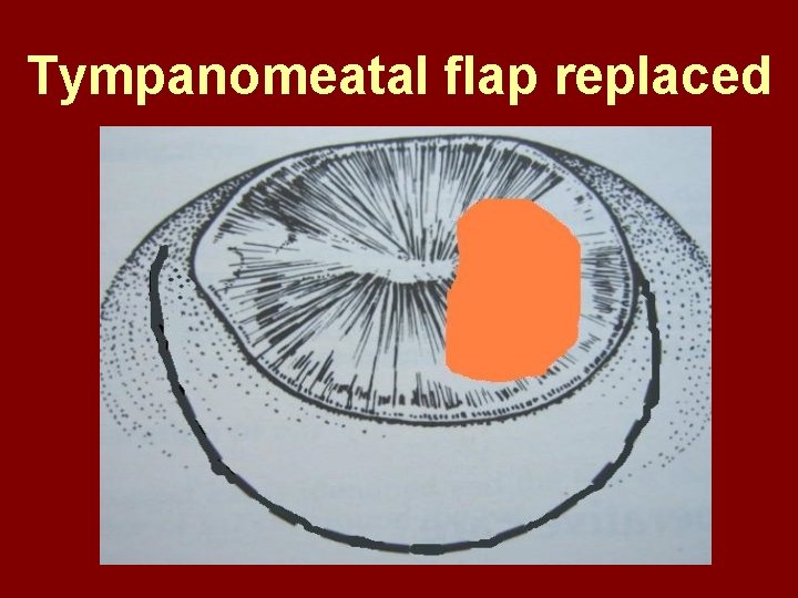 Tympanomeatal flap replaced 