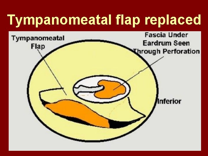 Tympanomeatal flap replaced 