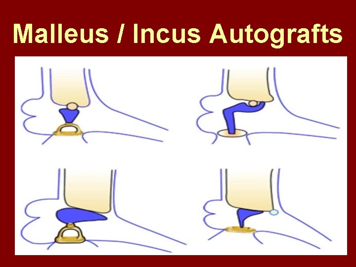 Malleus / Incus Autografts 