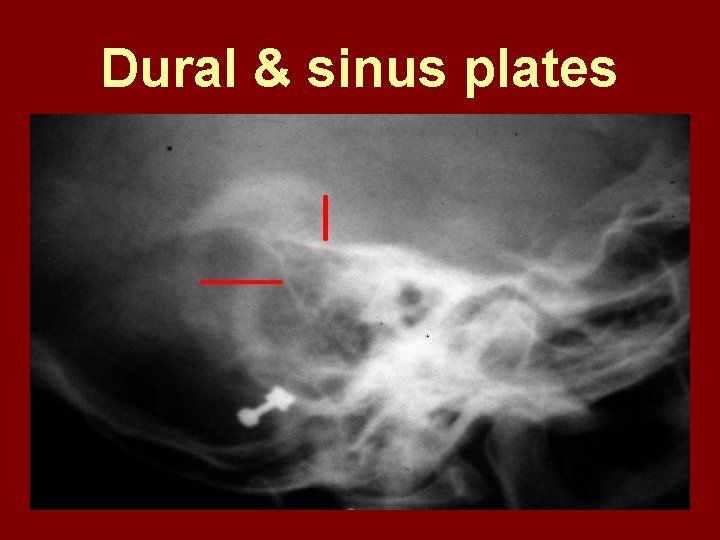 Dural & sinus plates 