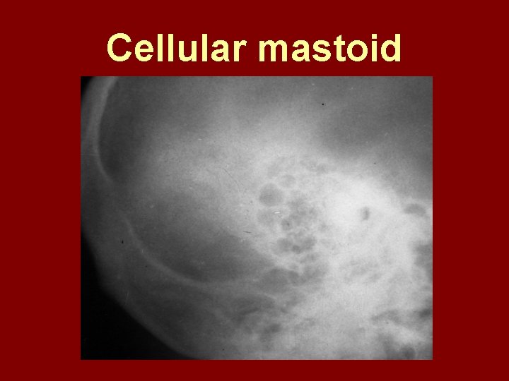 Cellular mastoid 