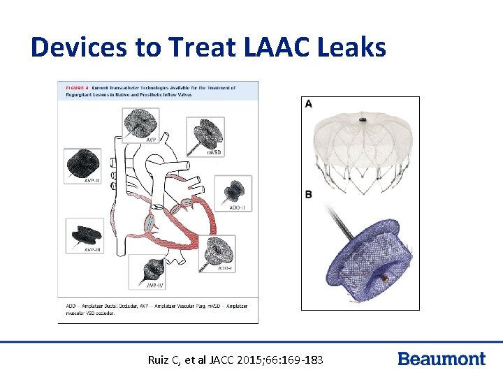 Devices to Treat LAAC Leaks Ruiz C, et al JACC 2015; 66: 169 -183 Devices to Treat LAAC Leaks Ruiz C, et al JACC 2015; 66: 169 -183