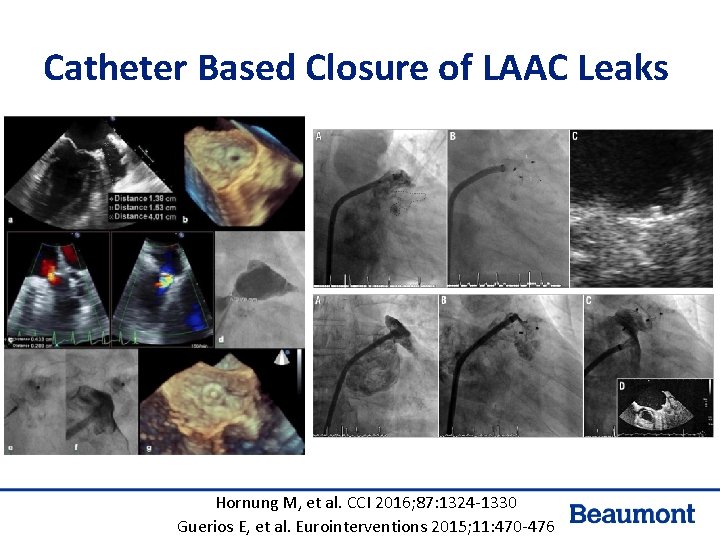 Catheter Based Closure of LAAC Leaks Hornung M, et al. CCI 2016; 87: 1324 Catheter Based Closure of LAAC Leaks Hornung M, et al. CCI 2016; 87: 1324