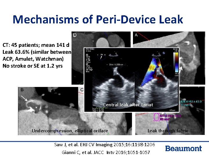 Mechanisms of Peri-Device Leak CT: 45 patients; mean 141 d Leak 63. 6% (similar Mechanisms of Peri-Device Leak CT: 45 patients; mean 141 d Leak 63. 6% (similar