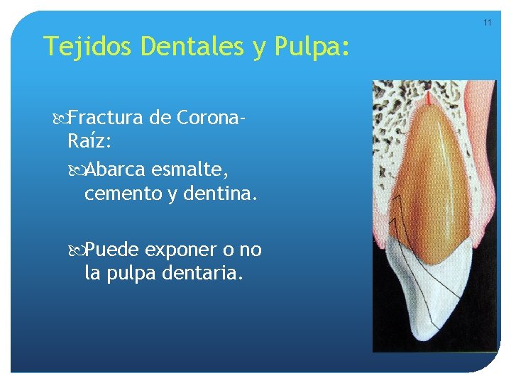 11 Tejidos Dentales y Pulpa: Fractura de Corona. Raíz: Abarca esmalte, cemento y dentina. 11 Tejidos Dentales y Pulpa: Fractura de Corona. Raíz: Abarca esmalte, cemento y dentina.