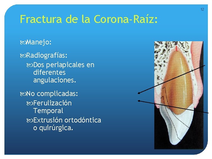 12 Fractura de la Corona-Raíz: Manejo: Radiografías: Dos periapicales en diferentes angulaciones. No complicadas: 12 Fractura de la Corona-Raíz: Manejo: Radiografías: Dos periapicales en diferentes angulaciones. No complicadas: