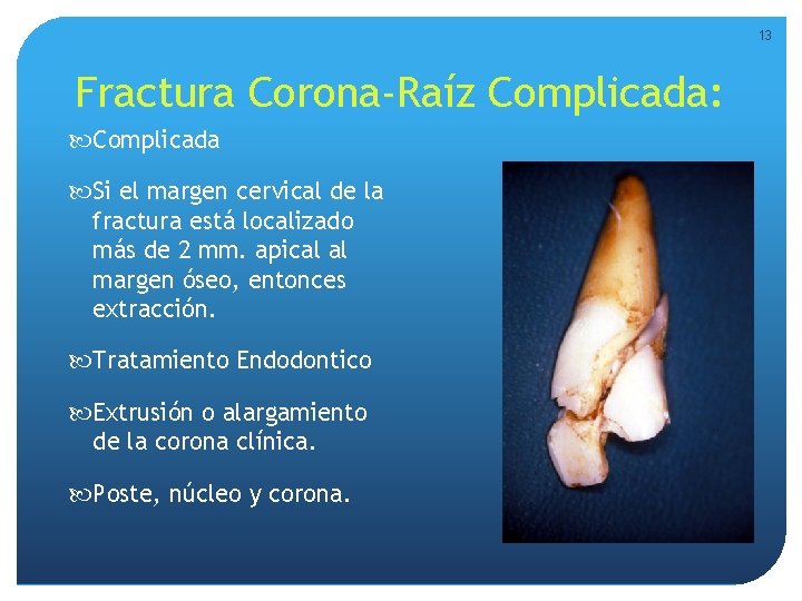 13 Fractura Corona-Raíz Complicada: Complicada Si el margen cervical de la fractura está localizado 13 Fractura Corona-Raíz Complicada: Complicada Si el margen cervical de la fractura está localizado