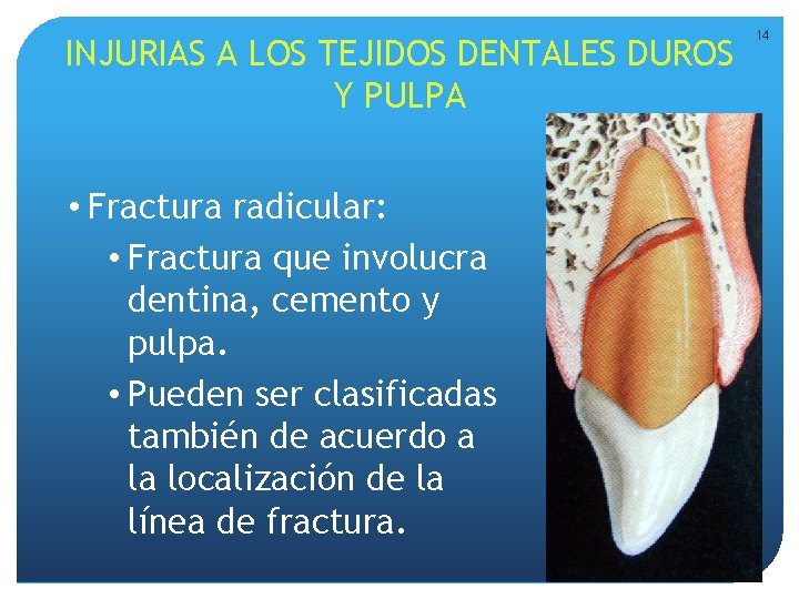 INJURIAS A LOS TEJIDOS DENTALES DUROS Y PULPA • Fractura radicular: • Fractura que INJURIAS A LOS TEJIDOS DENTALES DUROS Y PULPA • Fractura radicular: • Fractura que