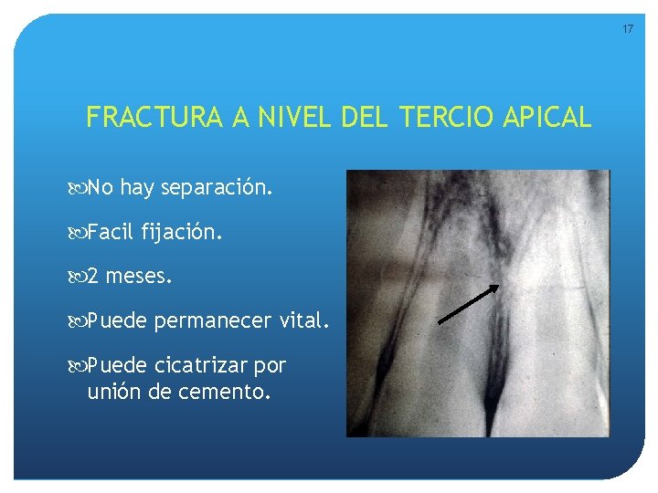 17 FRACTURA A NIVEL DEL TERCIO APICAL No hay separación. Facil fijación. 2 meses. 17 FRACTURA A NIVEL DEL TERCIO APICAL No hay separación. Facil fijación. 2 meses.