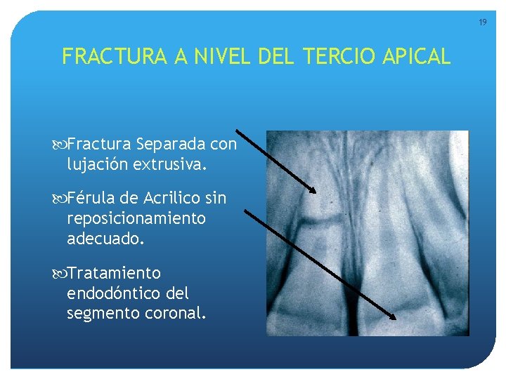 19 FRACTURA A NIVEL DEL TERCIO APICAL Fractura Separada con lujación extrusiva. Férula de 19 FRACTURA A NIVEL DEL TERCIO APICAL Fractura Separada con lujación extrusiva. Férula de