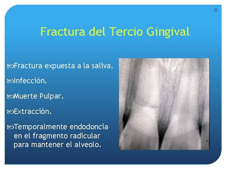 20 Fractura del Tercio Gingival Fractura expuesta a la saliva. Infección. Muerte Pulpar. Extracción. 20 Fractura del Tercio Gingival Fractura expuesta a la saliva. Infección. Muerte Pulpar. Extracción.