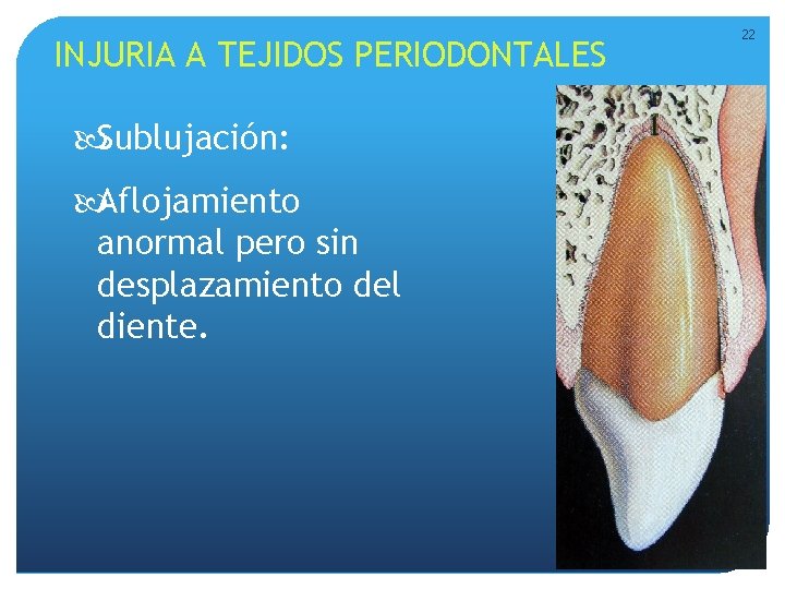 INJURIA A TEJIDOS PERIODONTALES Sublujación: Aflojamiento anormal pero sin desplazamiento del diente. 22 INJURIA A TEJIDOS PERIODONTALES Sublujación: Aflojamiento anormal pero sin desplazamiento del diente. 22