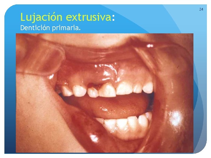Lujación extrusiva: Dentición primaria. 24 Lujación extrusiva: Dentición primaria. 24