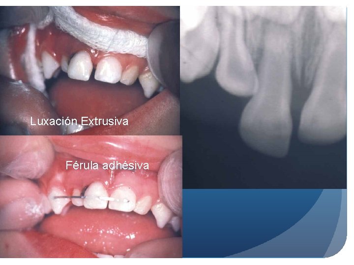 26 Luxación Extrusiva Férula adhésiva 26 Luxación Extrusiva Férula adhésiva
