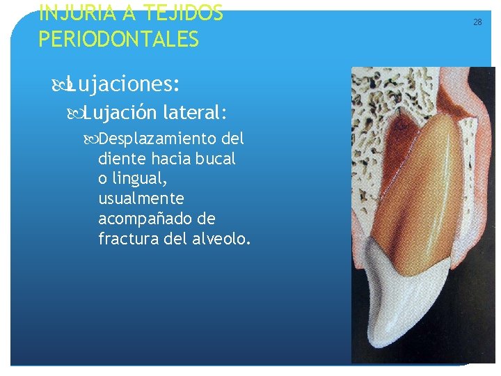 INJURIA A TEJIDOS PERIODONTALES Lujaciones: Lujación lateral: Desplazamiento del diente hacia bucal o lingual, INJURIA A TEJIDOS PERIODONTALES Lujaciones: Lujación lateral: Desplazamiento del diente hacia bucal o lingual,