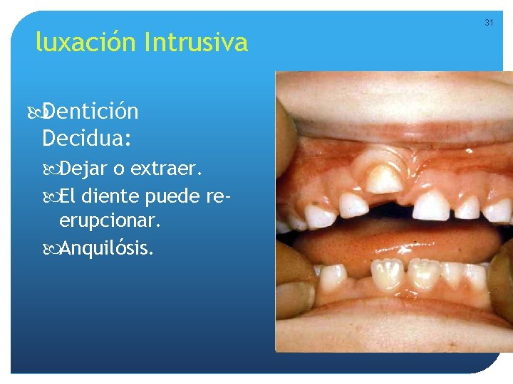 luxación Intrusiva Dentición Decidua: Dejar o extraer. El diente puede reerupcionar. Anquilósis. 31 luxación Intrusiva Dentición Decidua: Dejar o extraer. El diente puede reerupcionar. Anquilósis. 31