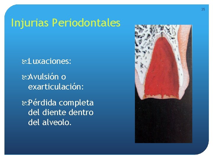 35 Injurias Periodontales Luxaciones: Avulsión o exarticulación: Pérdida completa del diente dentro del alveolo. 35 Injurias Periodontales Luxaciones: Avulsión o exarticulación: Pérdida completa del diente dentro del alveolo.