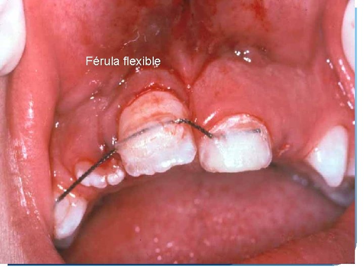 39 Exarticulation: Férula flexible 39 Exarticulation: Férula flexible