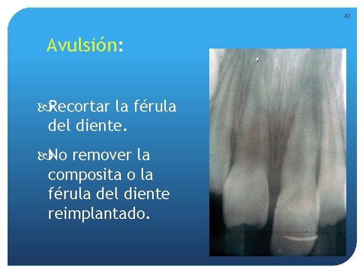 43 Avulsión: Recortar la férula del diente. No remover la composita o la férula 43 Avulsión: Recortar la férula del diente. No remover la composita o la férula