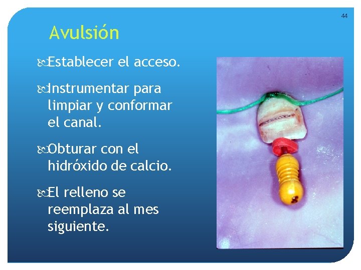 44 Avulsión Establecer el acceso. Instrumentar para limpiar y conformar el canal. Obturar con 44 Avulsión Establecer el acceso. Instrumentar para limpiar y conformar el canal. Obturar con
