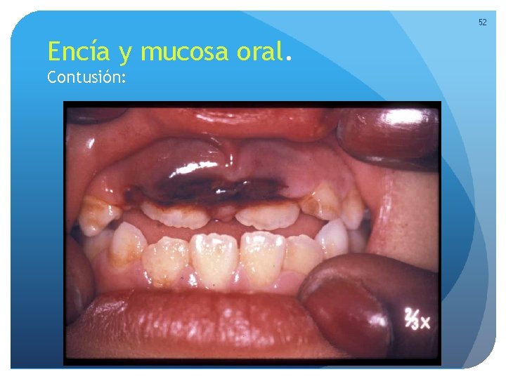 52 Encía y mucosa oral. Contusión: 52 Encía y mucosa oral. Contusión: