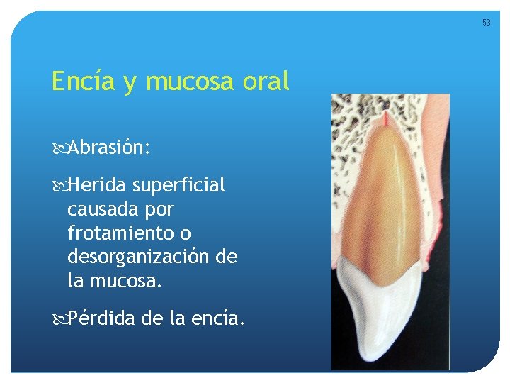 53 Encía y mucosa oral Abrasión: Herida superficial causada por frotamiento o desorganización de 53 Encía y mucosa oral Abrasión: Herida superficial causada por frotamiento o desorganización de