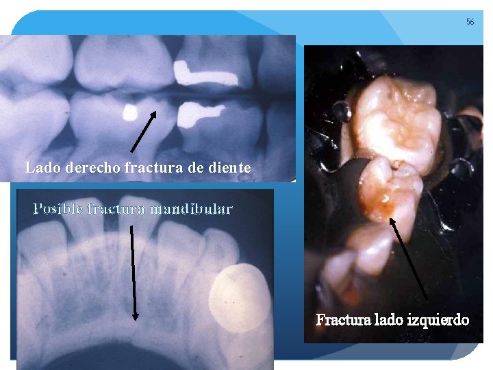 56 Lado derecho fractura de diente Posible fractura mandibular Fractura lado izquierdo 56 Lado derecho fractura de diente Posible fractura mandibular Fractura lado izquierdo