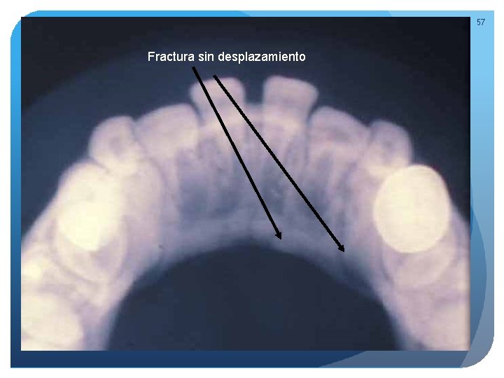 57 Fractura sin desplazamiento Fractura a través del espacio del incisivo lateral 57 Fractura sin desplazamiento Fractura a través del espacio del incisivo lateral