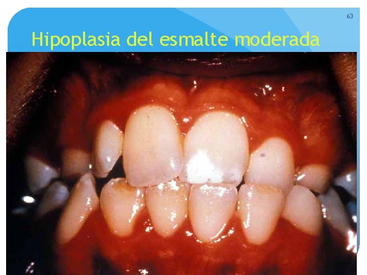 63 Hipoplasia del esmalte moderada 63 Hipoplasia del esmalte moderada