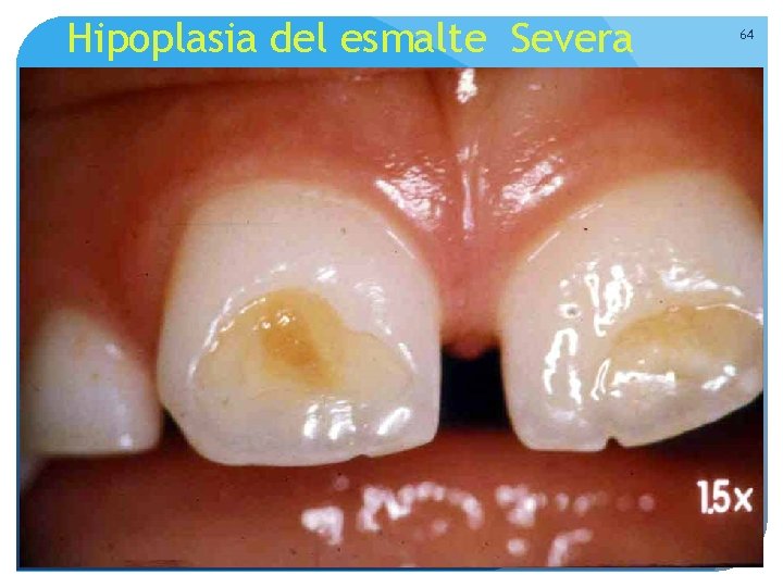 Hipoplasia del esmalte Severa 64 Hipoplasia del esmalte Severa 64