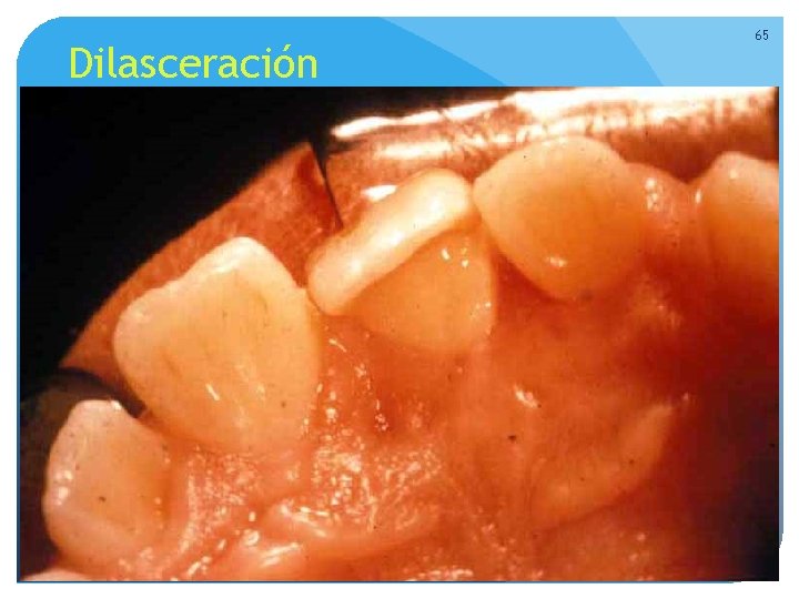 Dilasceración 65 Dilasceración 65