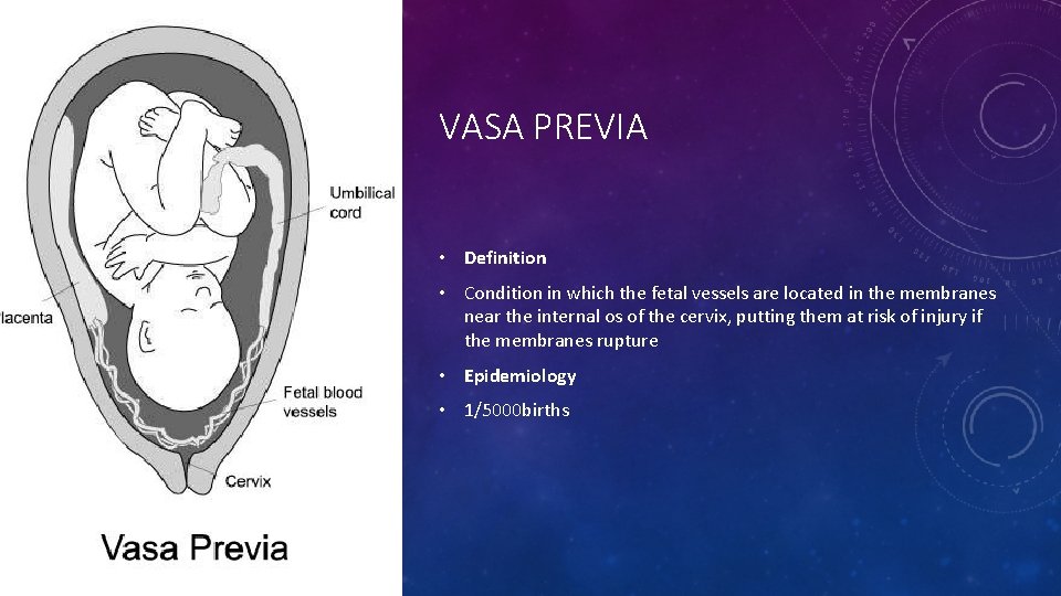 VASA PREVIA • Definition • Condition in which the fetal vessels are located in