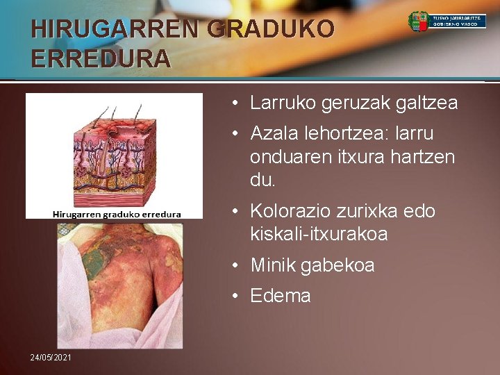 HIRUGARREN GRADUKO ERREDURA • Larruko geruzak galtzea • Azala lehortzea: larru onduaren itxura hartzen