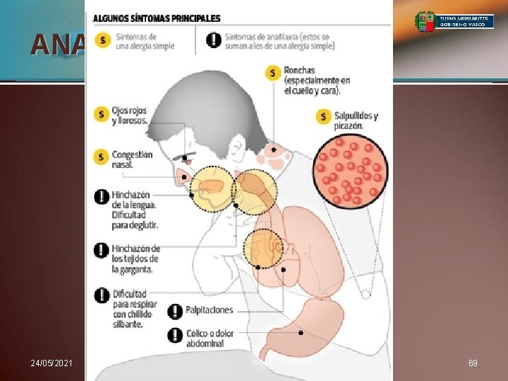 ANAFILAXIA Bat-bateko hasiera. Sintomak: • Azalekoak • Arnasketakoak • Digestiboak • Bihotzekoak 24/05/2021 69