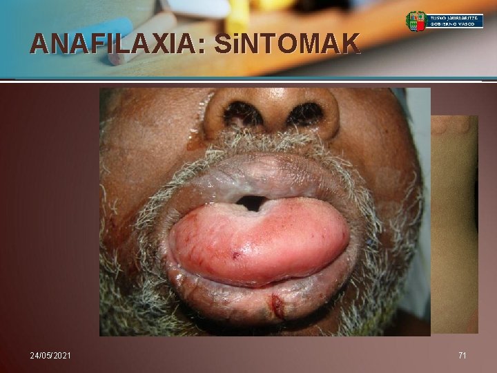 ANAFILAXIA: Si. NTOMAK 24/05/2021 71 