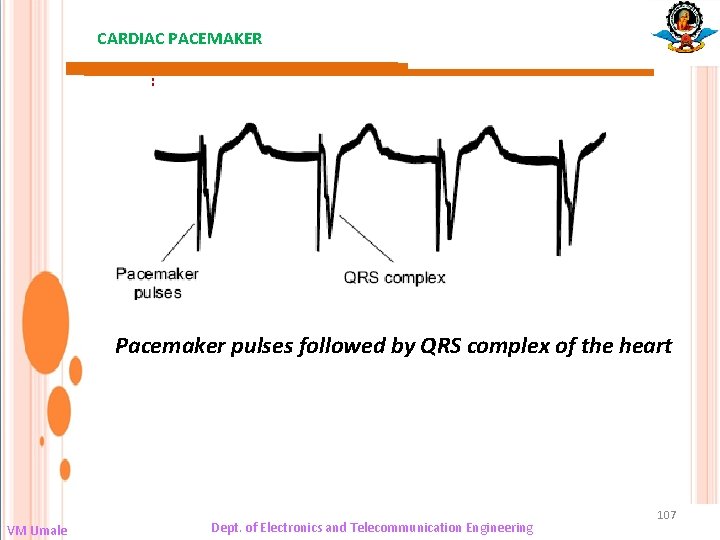 CARDIAC PACEMAKER : Pacemaker pulses followed by QRS complex of the heart VM Umale