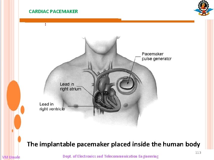 CARDIAC PACEMAKER : The implantable pacemaker placed inside the human body VM Umale Dept.