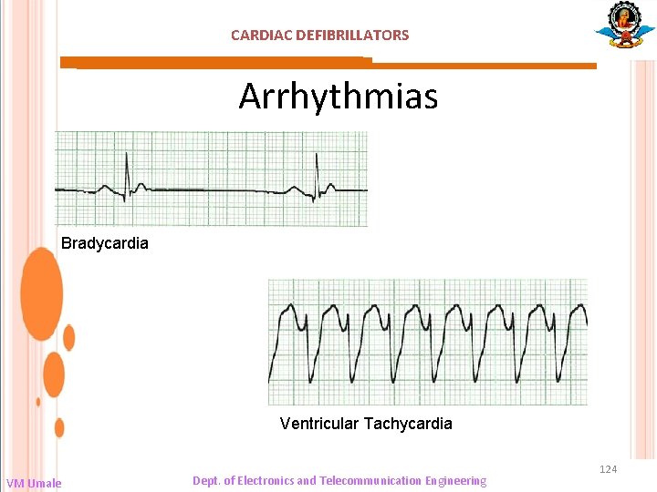 CARDIAC DEFIBRILLATORS Arrhythmias Bradycardia Ventricular Tachycardia VM Umale Dept. of Electronics and Telecommunication Engineering